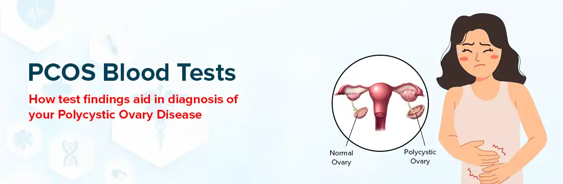 PCOS Blood Tests : How test findings aid in diagnosis of your Polycystic Ovary Disease